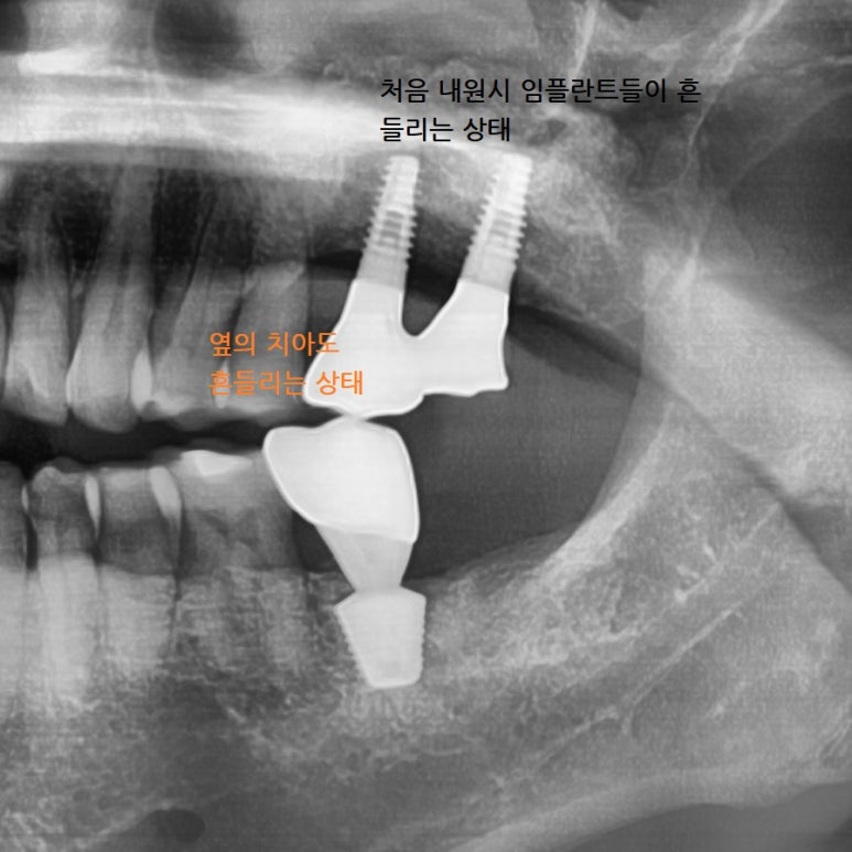 [서울시청역치과] 다른 치과에서 오래전에 한 임플란트가 흔들려요 &rarr;재수술 케이스 관련 이미지 6