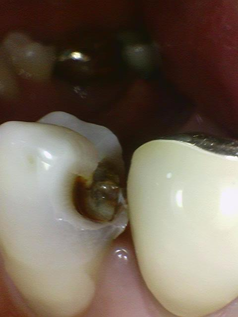 [충정로/치과]신경치료 할 만큼의 충치 제거 과정 공개 관련 이미지 4