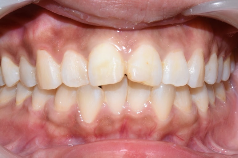 서대문역 지르코니아 크라운, 연세예감치과에서 알려드려요[실제환자사례] 관련 이미지 6
