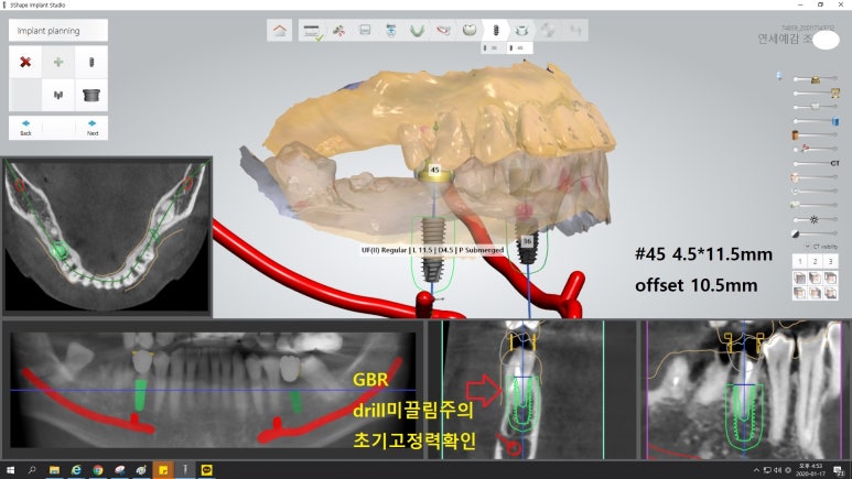 [북창동 치과/연세예감치과]내비게이션임플란트소개 관련 이미지 5