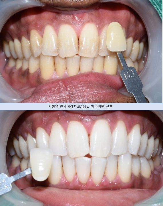 서울에서 치아미백 하는 치과 찾고 계신가요? 해외에서도 미백하러 오는 시청역 치과 미백비용 관련 이미지 6