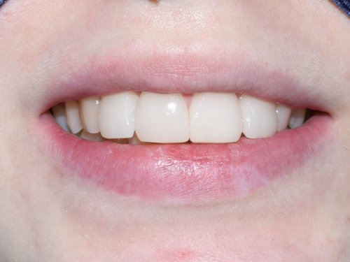 [서울역/을지로/치과] 본인이 옥니라고 생각한다면? 무삭제 라미네이트 어떤가요? 케이스 및 가격비용 관련 이미지 8