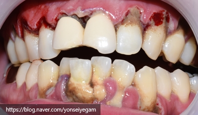 시청역/광화문/서울역 보험 스케일링안내(+치아미백이벤트안내) 관련 이미지 1