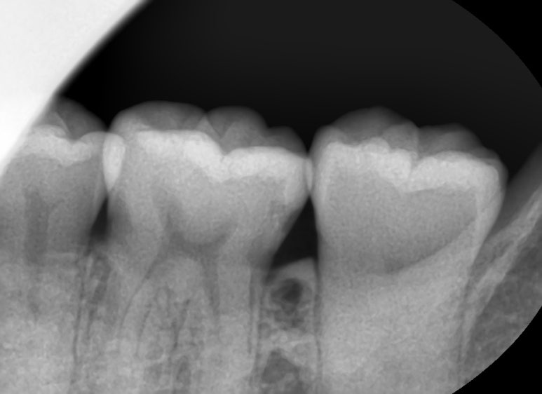 시청역치과 객관적인 근거로 치료하며, 환자분께 치료 전 치료해야하는 이유를 보여드립니다. 관련 이미지 4