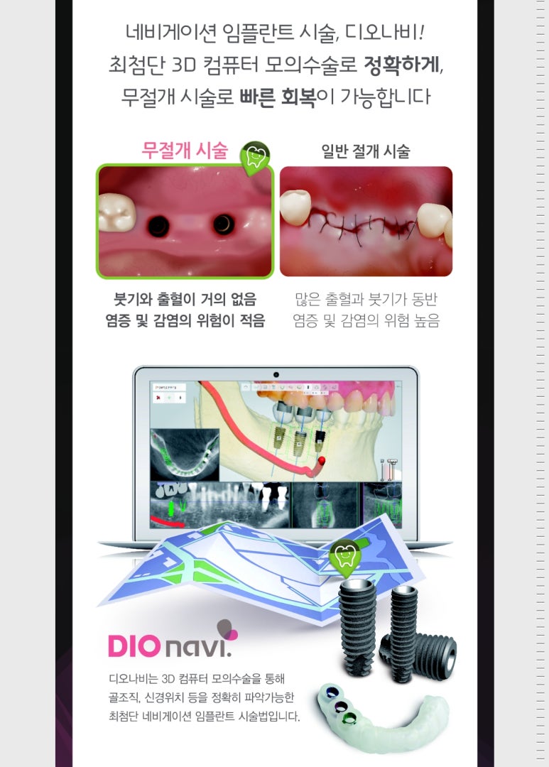 Navigation Dental Implant in Seoul, Korea. 관련 이미지 20