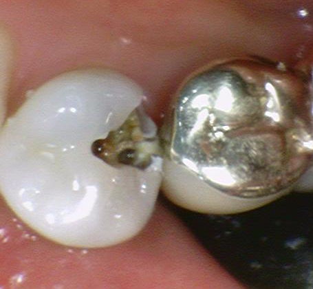 [충정로/치과]신경치료 할 만큼의 충치 제거 과정 공개 관련 이미지 3