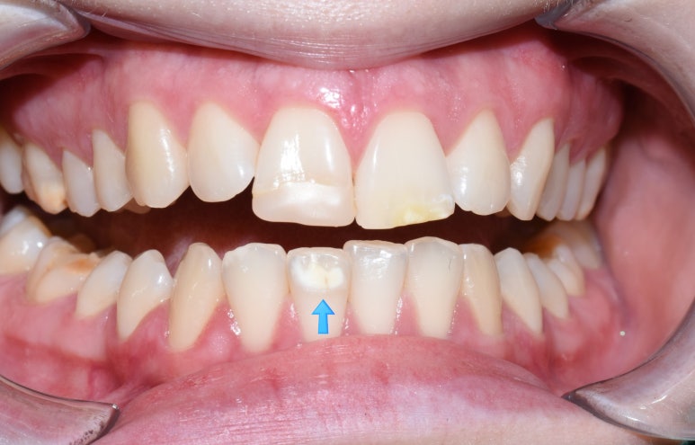 [서울역/시청역] 레진치료 : 화이트스팟(반상치) 케이스 & 치아패임으로 시린 케이스 & 깨진 치아 케이스 관련 이미지 4