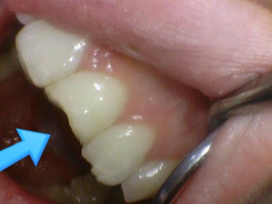 깨진 치아 레진치료 방법 실제사진 관련 이미지 2