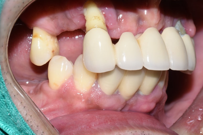 [임플란트/서울역] 서울 상악 전체인플란트 실제사례.극한의 케이스도 관련 이미지 2