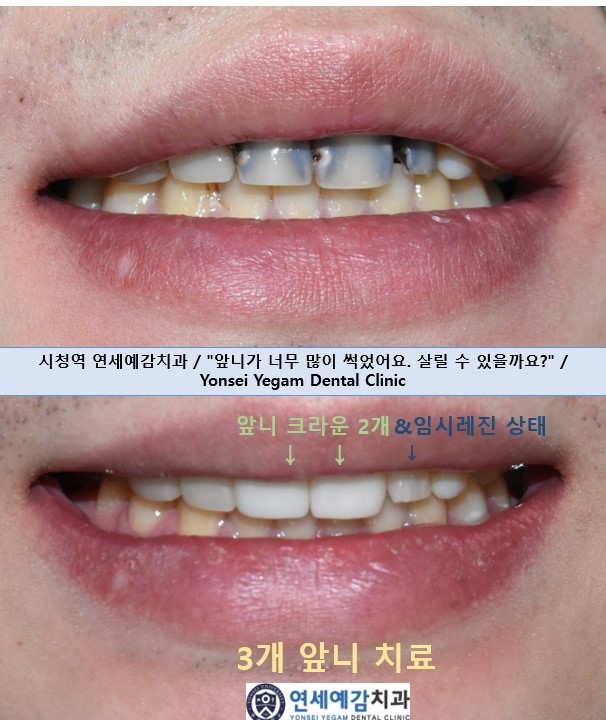시청역치과 치아가 부러졌어요 치아가 너무 많이 썩어서 앞니가 거의 없는 치아의 크라운 케이스 관련 이미지 1