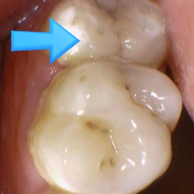 [서울시청역] 눈에 보이지 않는 충치 실제사진 관련 이미지 2