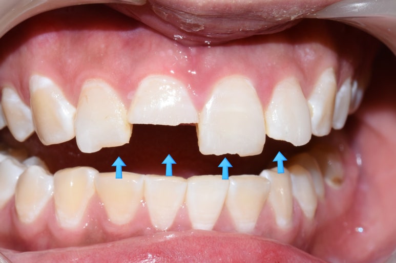 [서대문가까운/치과] 깨진 치아 레진 떼운 사례 관련 이미지 1
