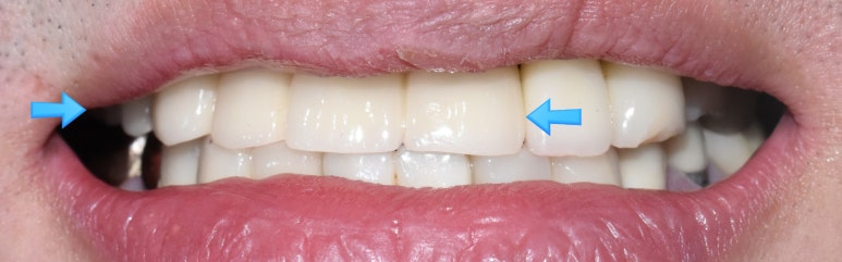 앞니 여러개 임플란트 잘하는 치과 서울역치과 실제사진 관련 이미지 16