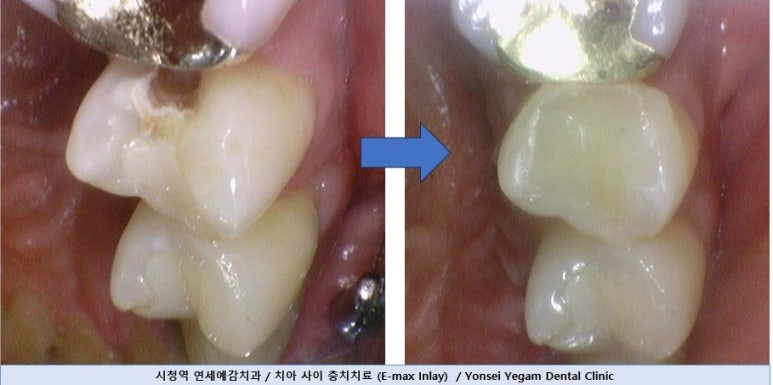 순화동 가까운 충치치료 치과 해외에서도 찾아오는 연세 예감 치과 관련 이미지 9
