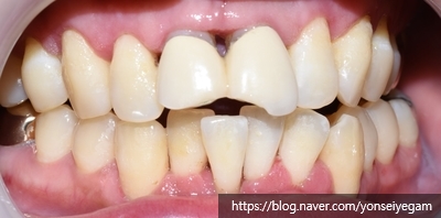 잇몸질환 평생 걱정안합니다??? 관련 이미지 4