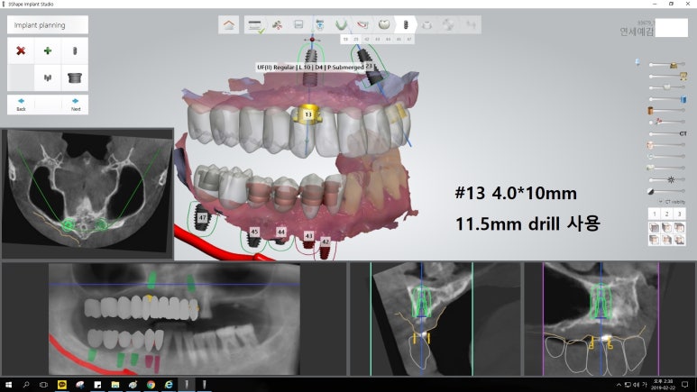 [남대문시장] 임플란트 조금 더 안아프고 간편하게 관련 이미지 8