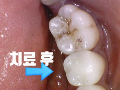 금크라운을 치아색 지르코니아 교체? 또는 크라운이 빠져서 새크라운?  광화문 시청역 서울역 치과, 가격까지! 관련 이미지 6