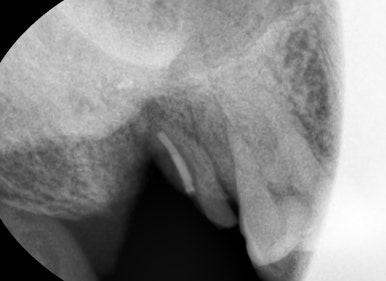 광화문 연세 예감 치과 해외에서도 찾아오는 지르코니아크라운 치료 안내해드려요 관련 이미지 13