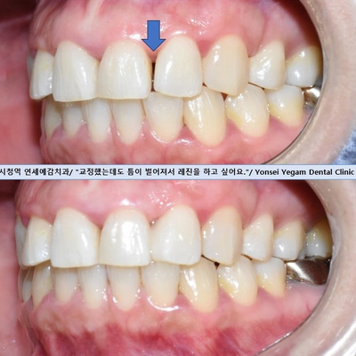앞니사이벌어짐, 레진으로 메울 수 있을까? 비용,가격까지. 종로치과/광화문 치과 관련 이미지 7