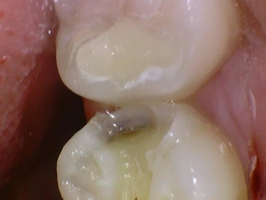 시청역치과 객관적인 근거로 치료하며, 환자분께 치료 전 치료해야하는 이유를 보여드립니다. 관련 이미지 5