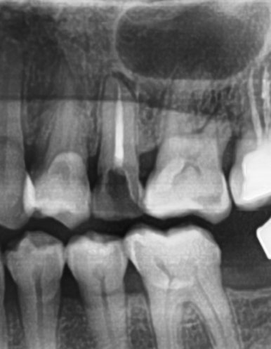 신경치료 끝났는데 크라운 해야하나요? 자연스러운 지르코니아 크라운 유명한 치과 가격까지 관련 이미지 1