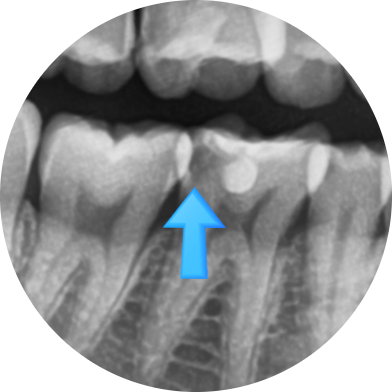 [서울시청역] 눈에 보이지 않는 충치 실제사진 관련 이미지 5