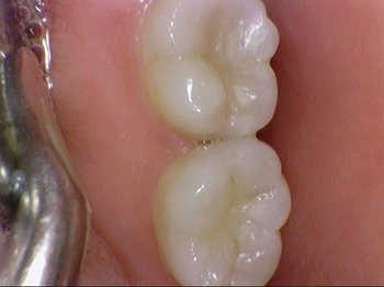 광화문/시청역"까만 아말감, 금니가 보기 싫다면?" 관련 이미지 6
