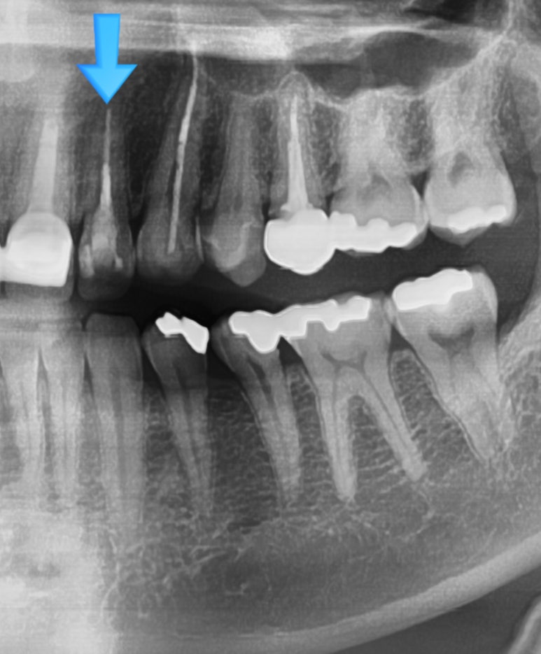 [시청역/서울역 치과] 앞니 치아부러짐 자연스럽게 치료사례 관련 이미지 13