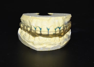 이갈이원인 증가요인 이갈이 치료방법 비용 관련 이미지 4