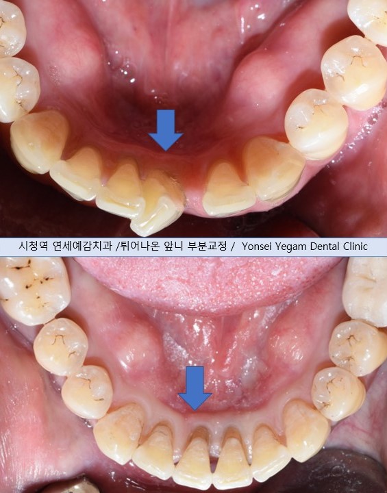 교정을 했었는데 앞니가 삐뚤어졌어요 &rarr;앞니 부분교정(재교정)사례. 2022 이벤트비용안내 관련 이미지 7
