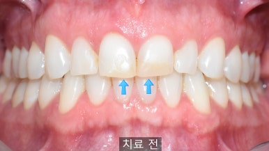 앞니 레진이 오래되어서 변색된 레진 교체 케이스 서울 시청 치과 관련 이미지 3