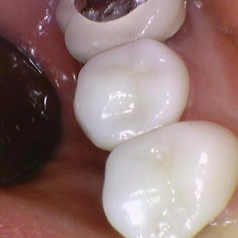 [서대문/광화문]외국인도 찾아오는 치아색나는 크라운, 지르코니아 크라운 치료 치과 어떻게 변하는지 확인해보아요 관련 이미지 5