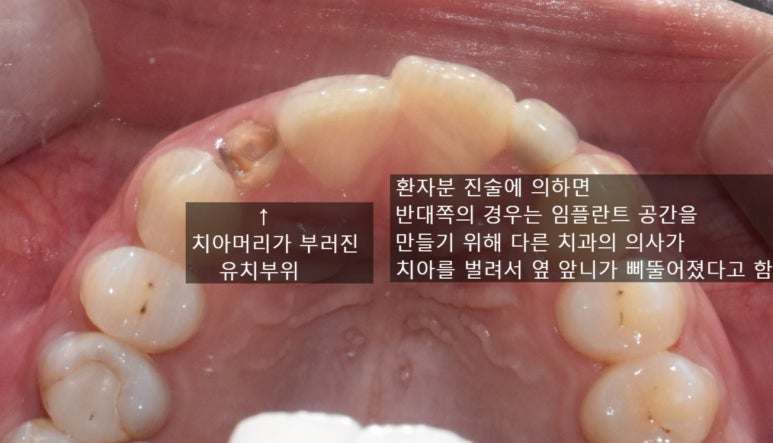 네비게이션임플란트 이용한 앞니 치료 유명한 치과 잔존 유치 케이스 관련 이미지 8
