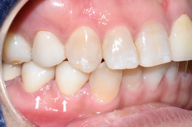 [서대문/광화문]외국인도 찾아오는 치아색나는 크라운, 지르코니아 크라운 치료 치과 어떻게 변하는지 확인해보아요 관련 이미지 4