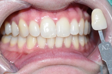 치아미백, 치과에서 하면 얼마나 오래갈까? 궁금하시다면, 실제사례 바탕으로 알아보아요 지속,유지 관련 이미지 7