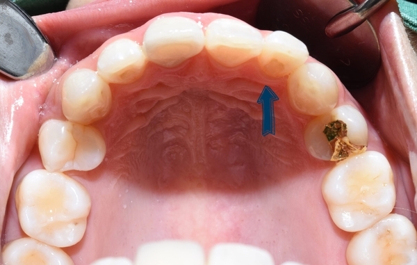 Q&A:"교정을 예전에 오래전에 했는데 앞니치아가 삐뚤어졌어요"해결방법은, 비용은? 관련 이미지 6
