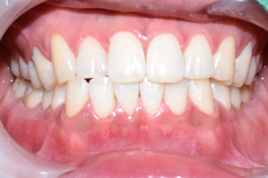 치아미백, 치과에서 하면 얼마나 오래갈까? 궁금하시다면, 실제사례 바탕으로 알아보아요 지속,유지 관련 이미지 2