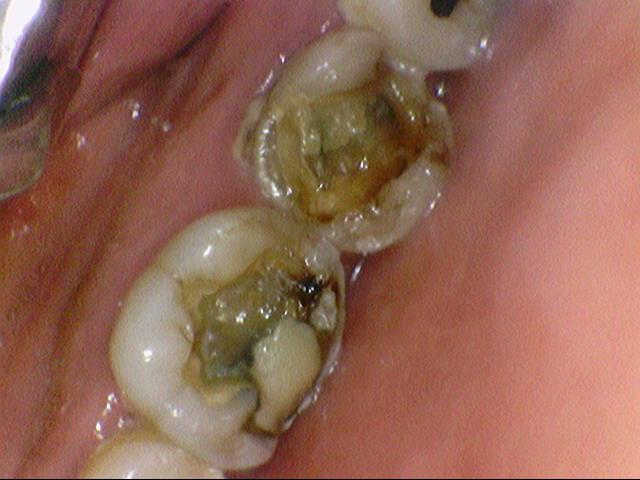 [서울시청역/남대문]어금니임플란트+상악동거상술(뼈이식):실제케이스 관련 이미지 3