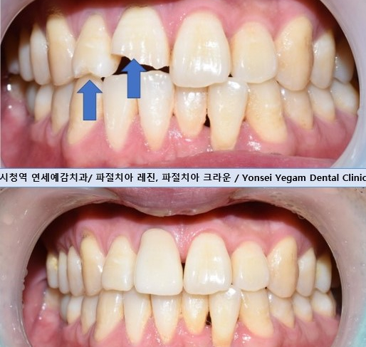 [광화문/연세예감치과] 앞니 치아가 파절되었다면? 앞니 부러짐.레진/크라운/임플란트 관련 이미지 10