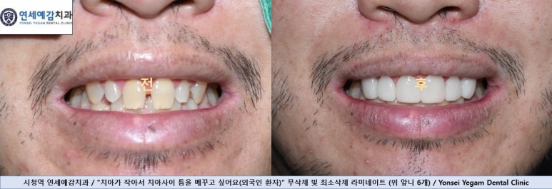 앞니가 작아 고민이신가요? 왜소치 무삭제 라미네이트로 자연스럽게 해결! 해외에서도 찾아오는 치과 비용까지 관련 이미지 2