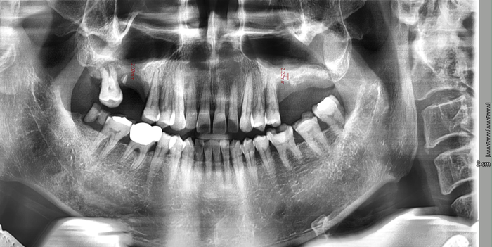 [서울시청역/남대문]어금니임플란트+상악동거상술(뼈이식):실제케이스 관련 이미지 2