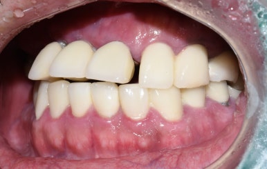 앞니 여러개 임플란트 잘하는 치과 서울역치과 실제사진 관련 이미지 10