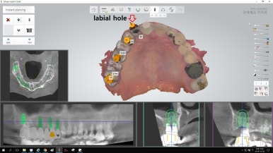앞니 여러개 임플란트 잘하는 치과 서울역치과 실제사진 관련 이미지 2