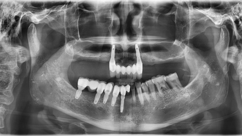 [남대문시장] 임플란트 조금 더 안아프고 간편하게 관련 이미지 3