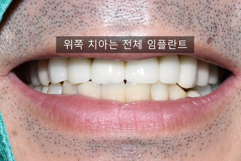 서울 중구 치과/이가 하나도 없는 환자의 치료방법/틀니, 풀아치임플란트, 전체 임플란트 등 관련 이미지 16