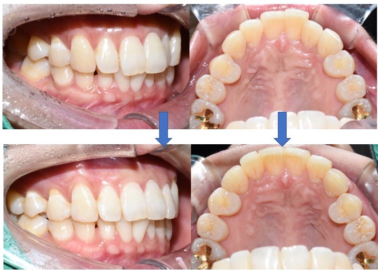 오래전 교정한 치아가 틀어져서 부분 재교정 케이스, 비용가격[광화문/서울역/치과] 관련 이미지 4