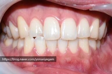 커피많이드세요? 치과에서 하는 치아미백 알려드려요[효과, 유지 등등 실제사례] 관련 이미지 8