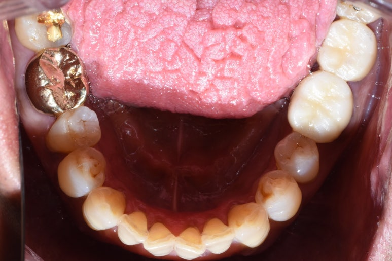 [서울역/광화문] 오래된 크라운에 음식물이 많이 껴요 &rarr;해결방법은? 관련 이미지 5