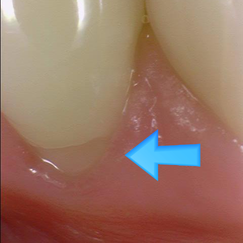 [서울역/시청역] 레진치료 : 화이트스팟(반상치) 케이스 & 치아패임으로 시린 케이스 & 깨진 치아 케이스 관련 이미지 1