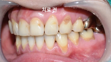 충정로치과,을지로치과/ 치아뿌리쪽이 패이고 부식된 것처럼 누렇게 보인 치경부 마모 레진 치료 증례 관련 이미지 3